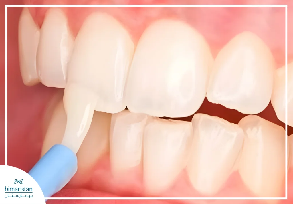 A Picture Illustrating How Fluoride Is Applied To Treat The Causes Of Tooth Decay.