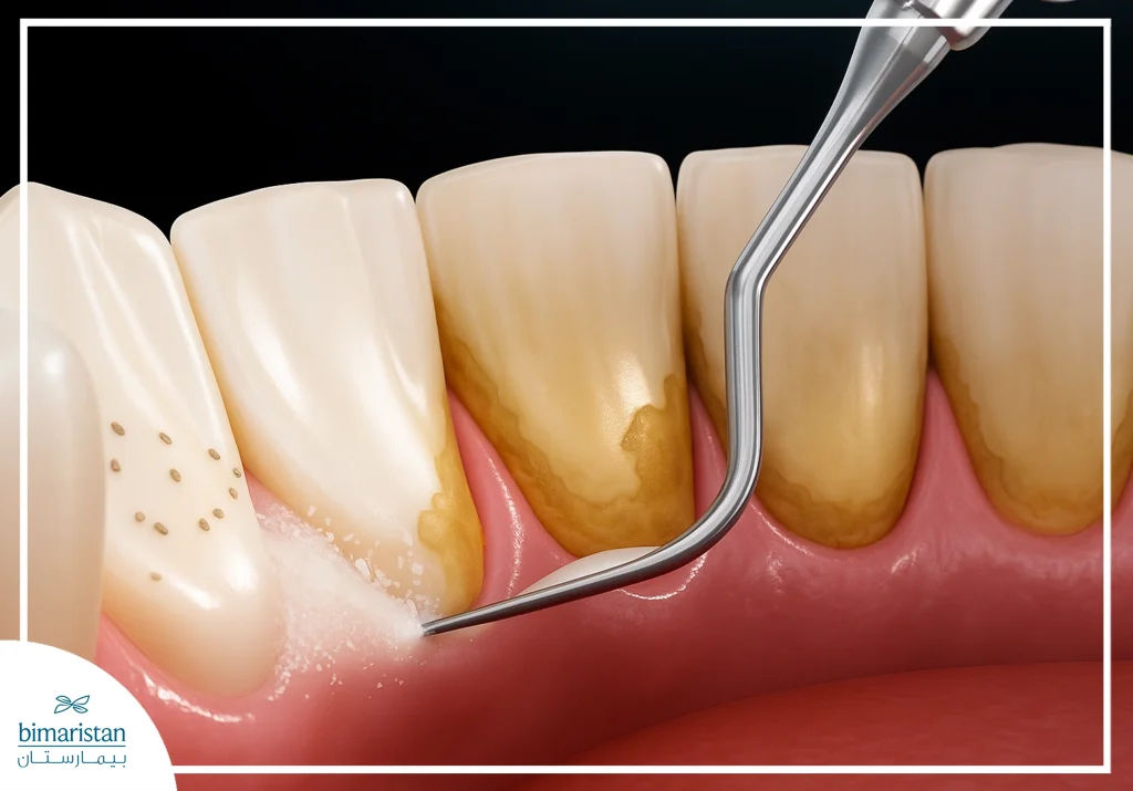 A Picture Illustrating Professional Cleaning Of Black Tartar At A Dentist'S Office Using Special Tools.