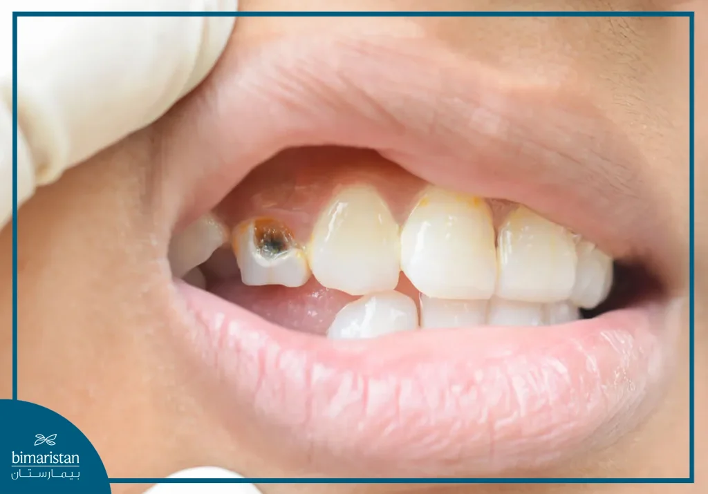 An Image Showing Tooth Decay