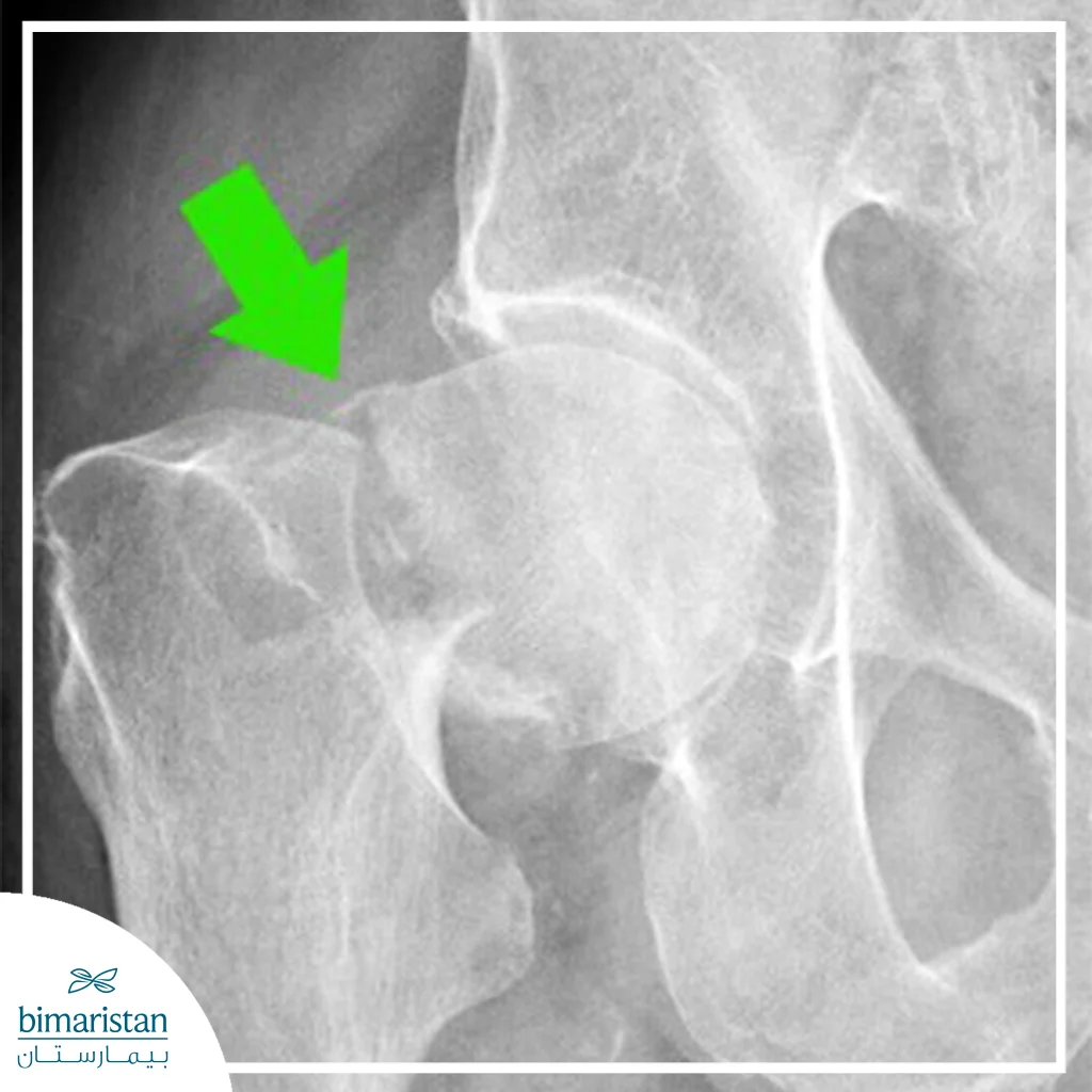 An X-Ray Image Showing A Clear Fracture Of The Femoral Neck