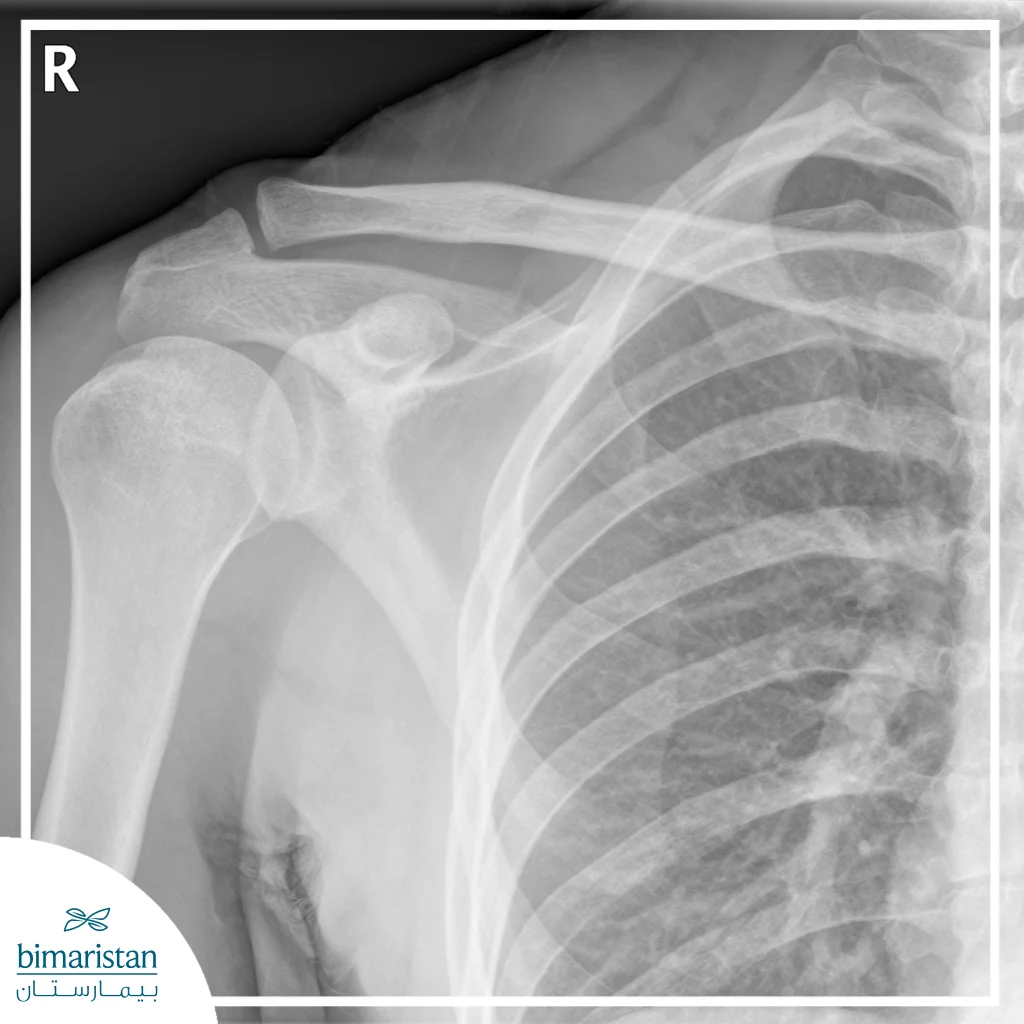 Shoulder Fracture: Causes, Diagnosis, And Treatment 7 An X-Ray Image Showing A Clear Fracture Of The Shoulder