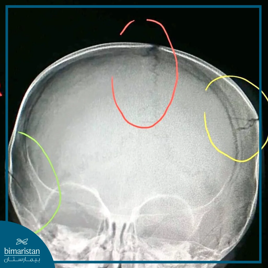 An X-Ray Image Showing Cracks In The Skull