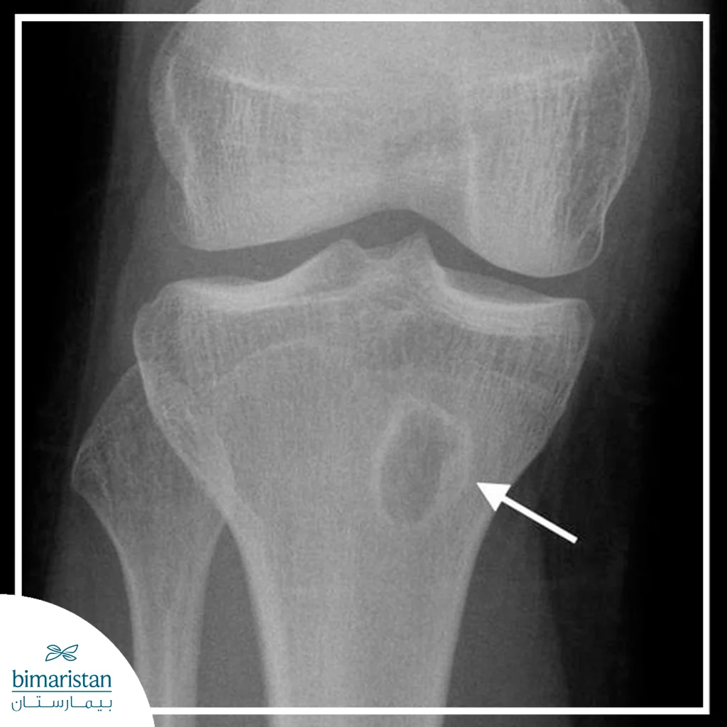 Osteomyelitis: Symptoms, Causes, And Comprehensive Treatment 7 An X-Ray Image Showing Osteomyelitis