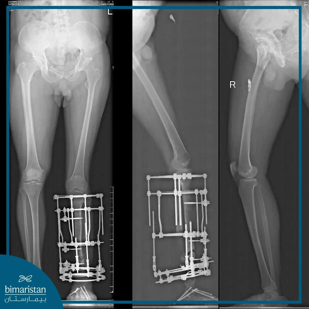 An X-Ray Image Showing The Precise Placement Of The Ilizarov Apparatus On The Lower Limb