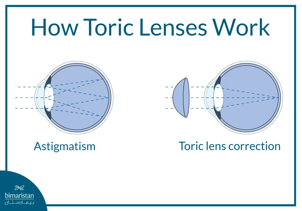 An Illustration Showing How Toric Lenses Correct Astigmatism By Compensating For The Irregular Curvature Of The Cornea.