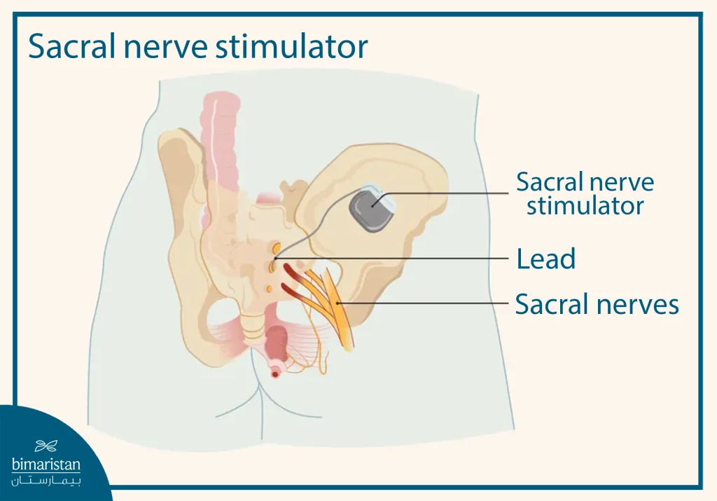 An Image Illustrating Neuromodulation For Neurogenic Bladder Treatment