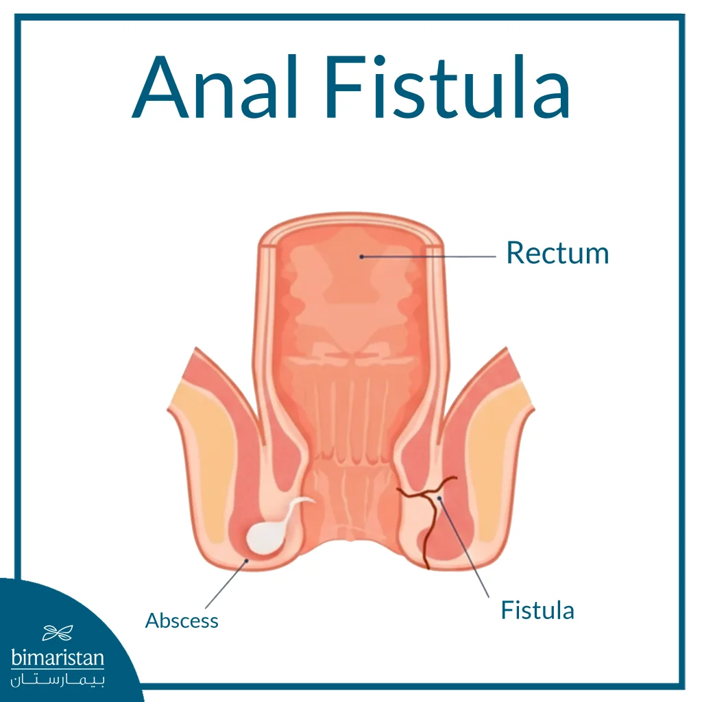An Image Illustrating An Anal Fistula.