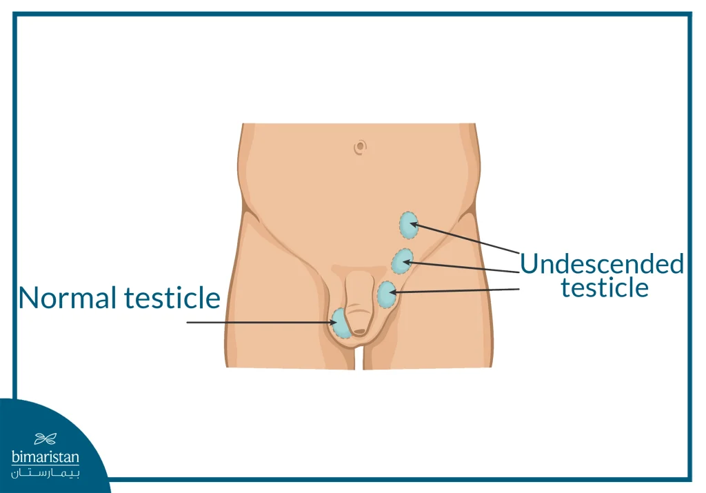 Pediatric Urology Surgery: Costs, Treatments, And Options In Turkey 3 An Image Illustrating The Condition Of Undescended Testis (Cryptorchidism) That Requires Pediatric Urology Surgery