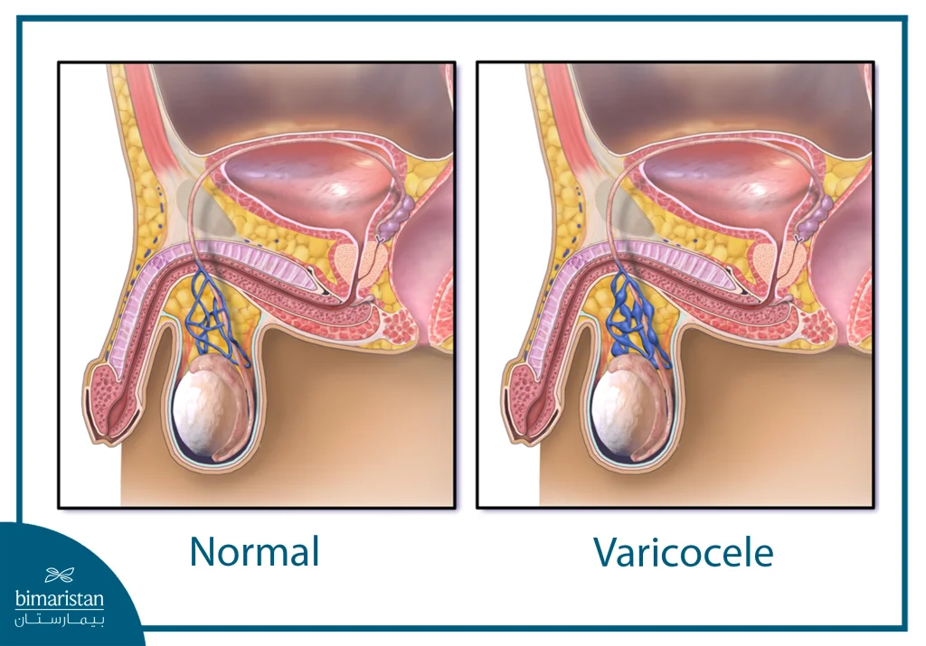 An Image Illustrating The Difference Between A Normal Testicle And A Testicle With A Varicocele