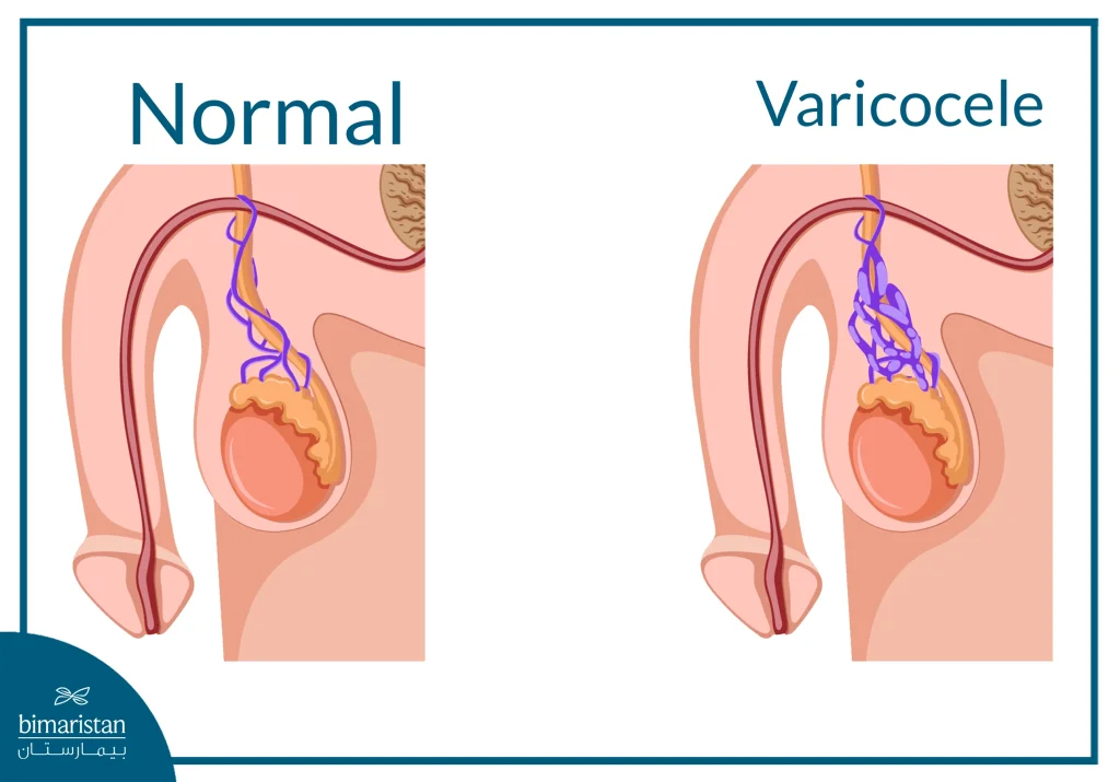 An Image Illustrating The Difference Between A Normal Testicle And A Testicle With A Varicocele