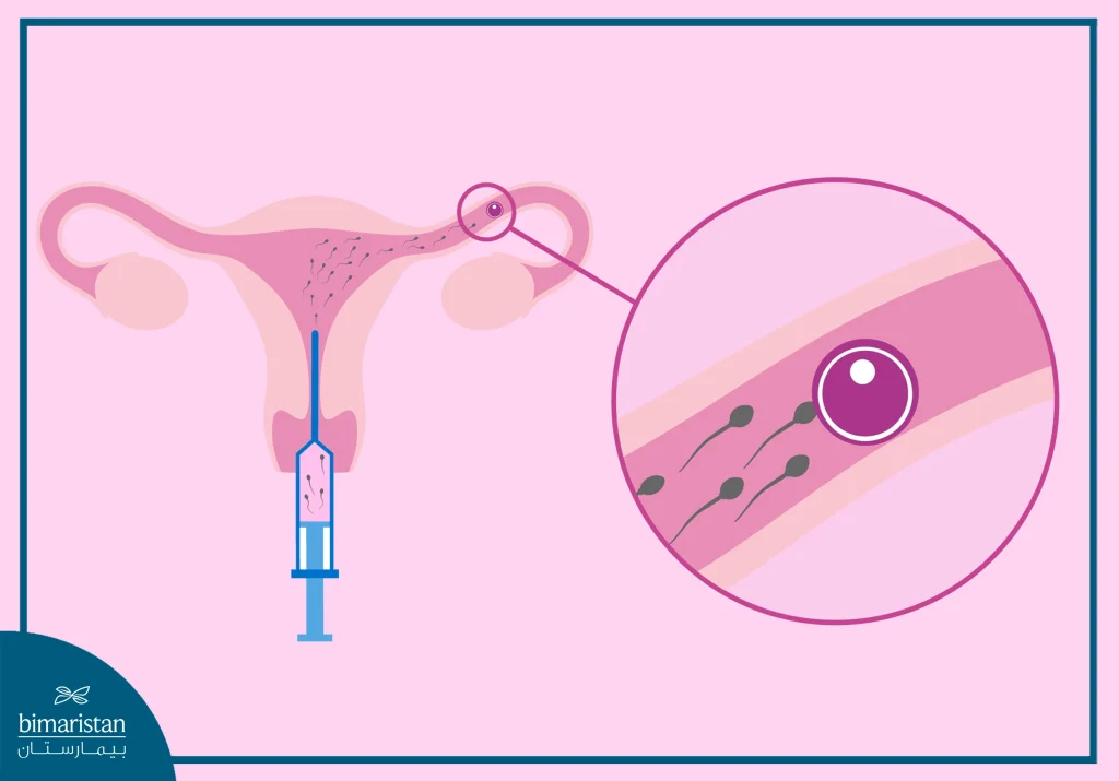 An Image Illustrating The In Vitro Fertilization (Ivf) Procedure