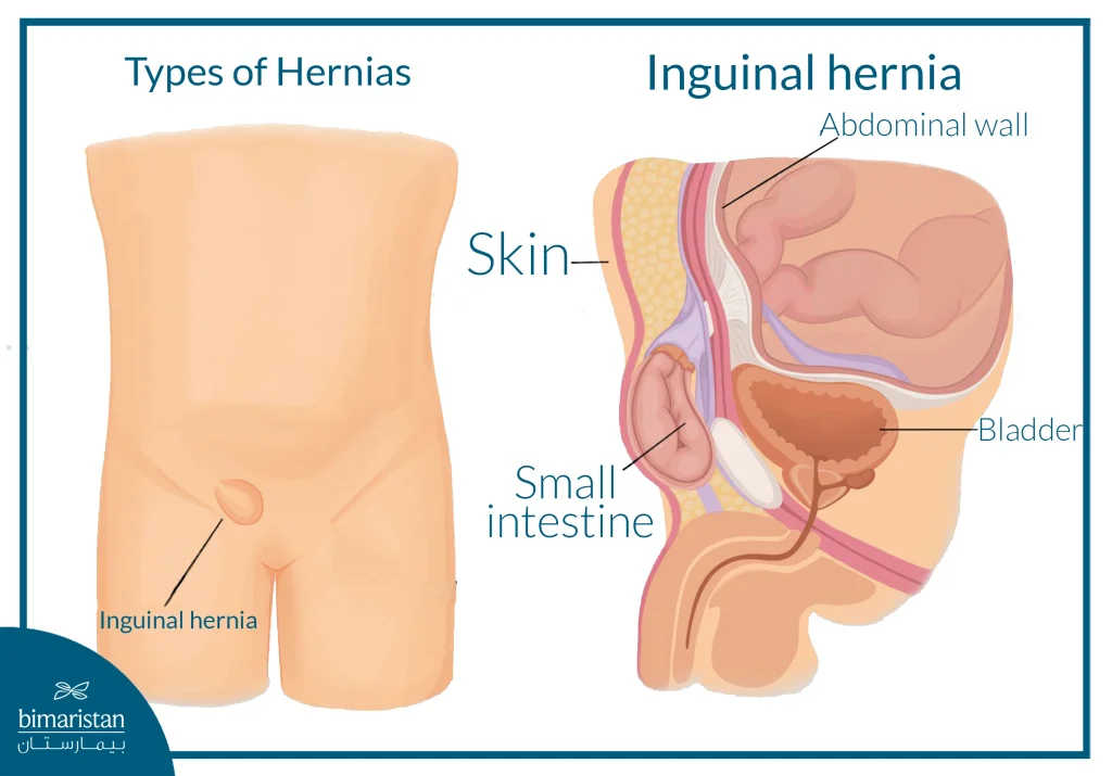Pediatric Urology Surgery: Costs, Treatments, And Options In Turkey 4 An Image Illustrating The Inguinal Hernia Condition