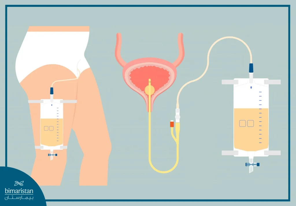 An Image Illustrating The Placement Of A Urinary Catheter