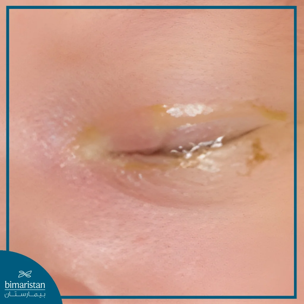 Conjunctivitis In Children: Causes, Symptoms, Treatment, And Prevention 2 An Image Showing A Child’s Closed Eye With Yellow Sticky Discharge On The Eyelid And Lashes, Indicating Bacterial Conjunctivitis