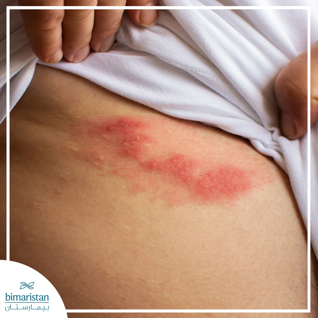 Symptoms Of Diabetes In It'S Early Stages: Comprehensive Guide 3 An Image Showing Fungal Infections, One Of The Early Symptoms Of Diabetes.