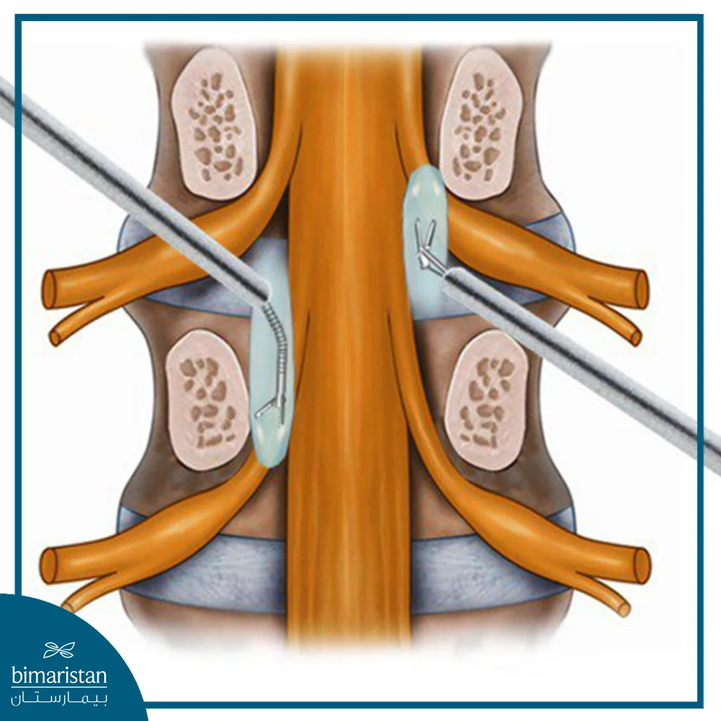 An Image Showing How The Arthroscopic Disc Operation Is Performed