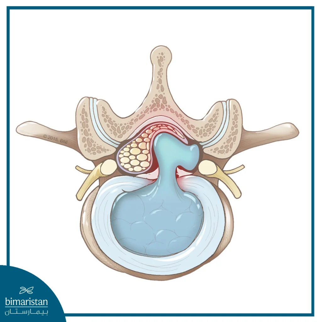 An Image Showing The Herniation Of The Disc And The Release Of The Gelatinous Material And Its Pressure On The Spinal Cord And The Adjacent Nerve