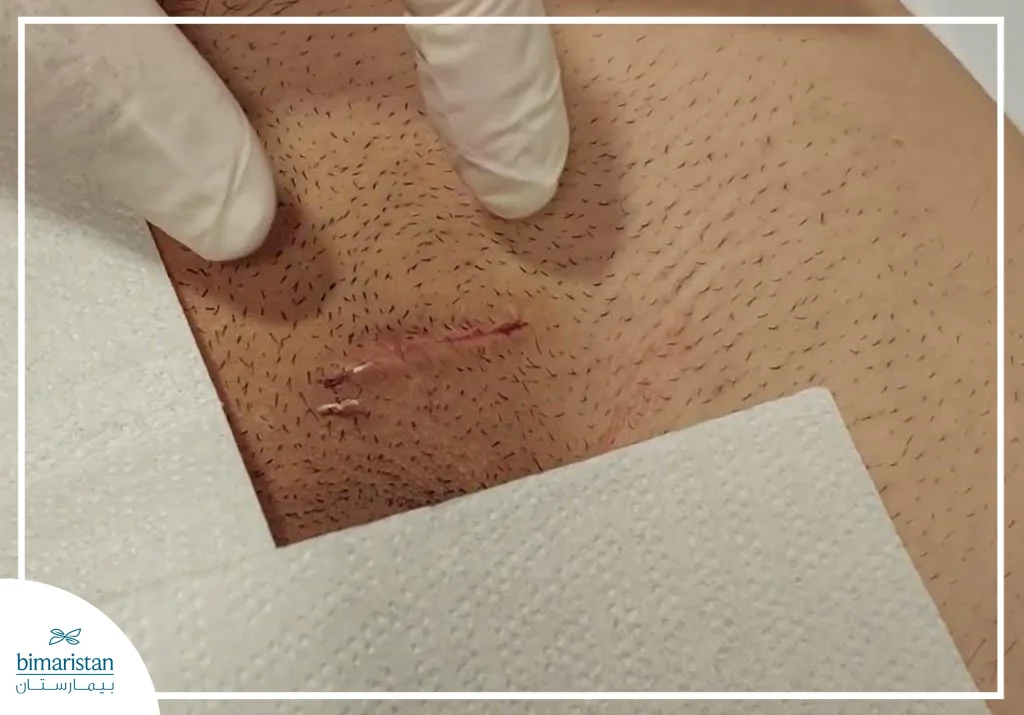 An Image Showing The Surgical Incision Used In Microsurgical Varicocelectomy