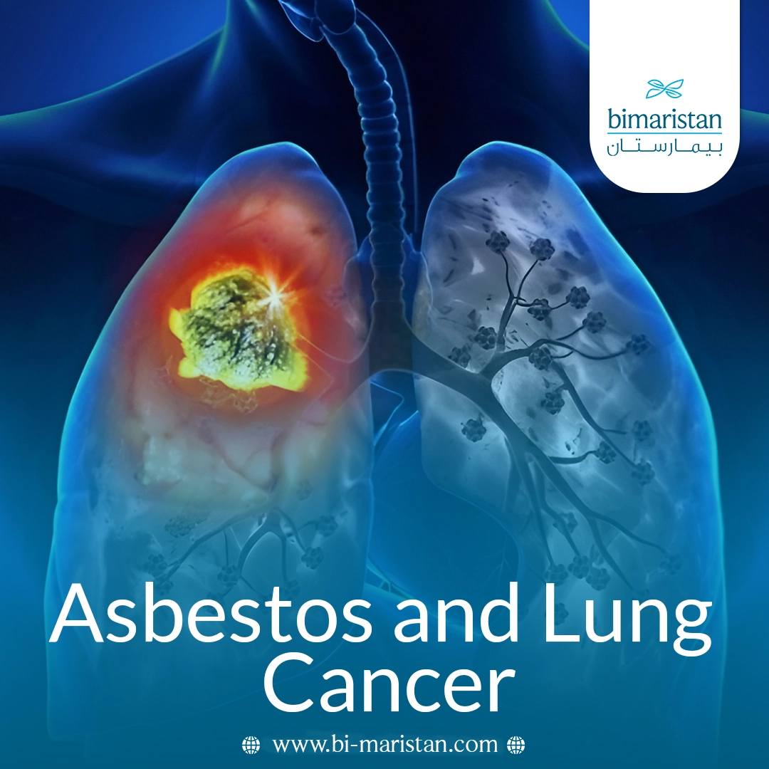 Asbestos And Lung Cancer: How Does Exposure To Asbestos Increase Your Risk? 4 Asbestos And Lung Cancer: How Does Exposure To Asbestos Increase Your Risk?
