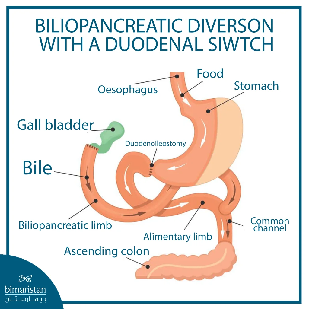 Biliopancreatic Diverson With A Duodenal Siwtch