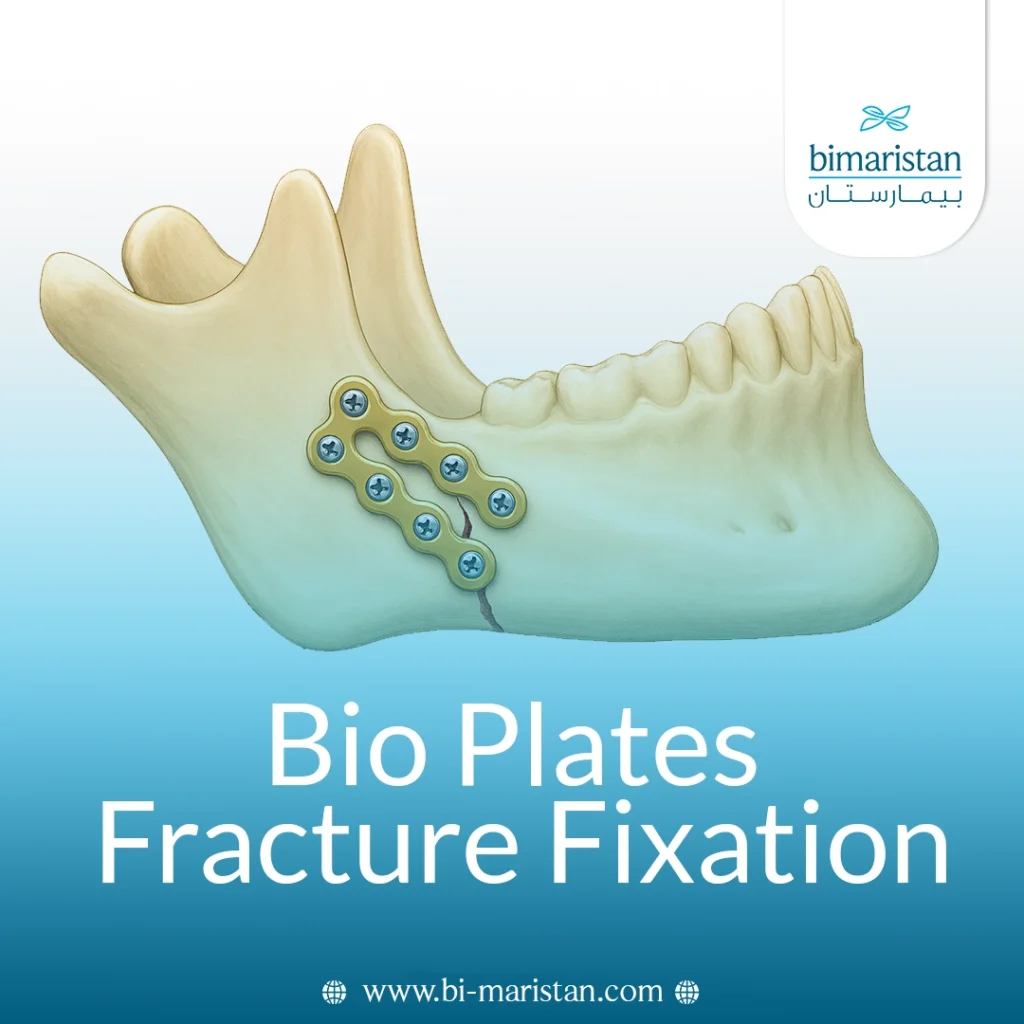 Fracture Stabilization With Bio-Plates