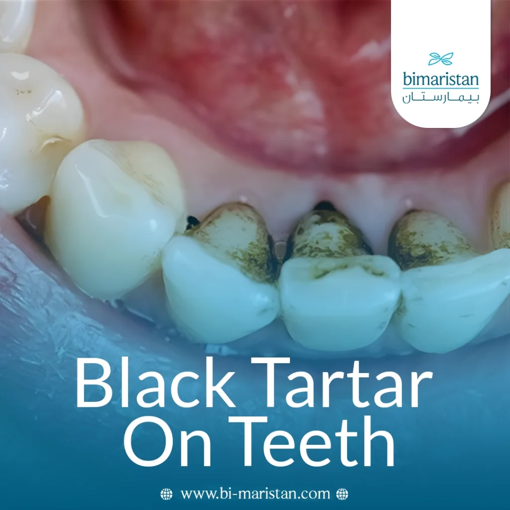 Black Tartar On Teeth