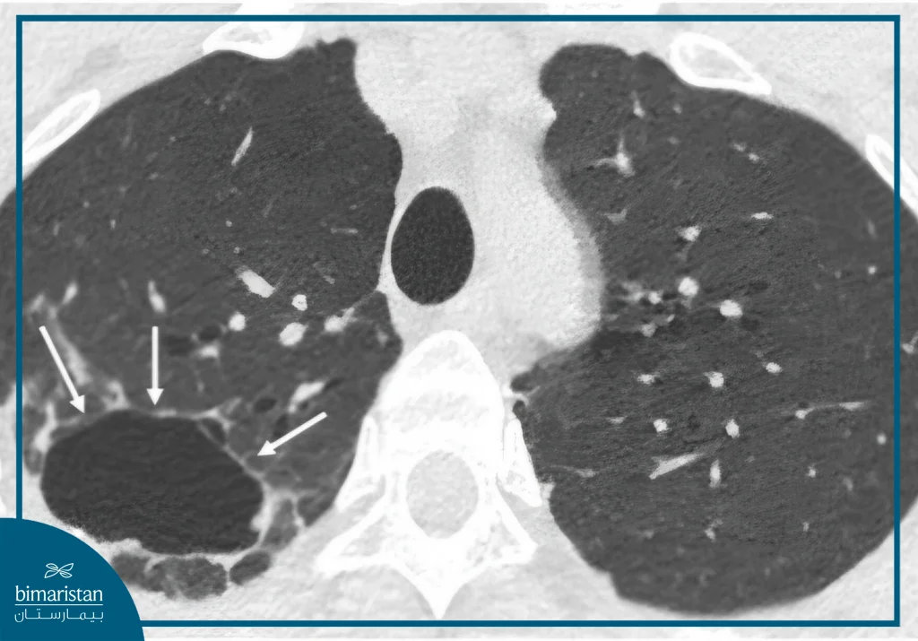 Ct Scan Image Showing Suspicious Pulmonary Nodule