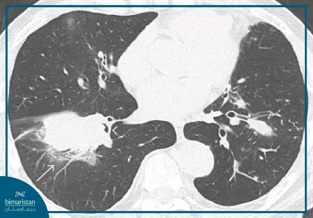 Ct Scan Of The Chest Showing A Central Lung Mass In The Left Lung, Consistent With Squamous Cell Lung Cancer