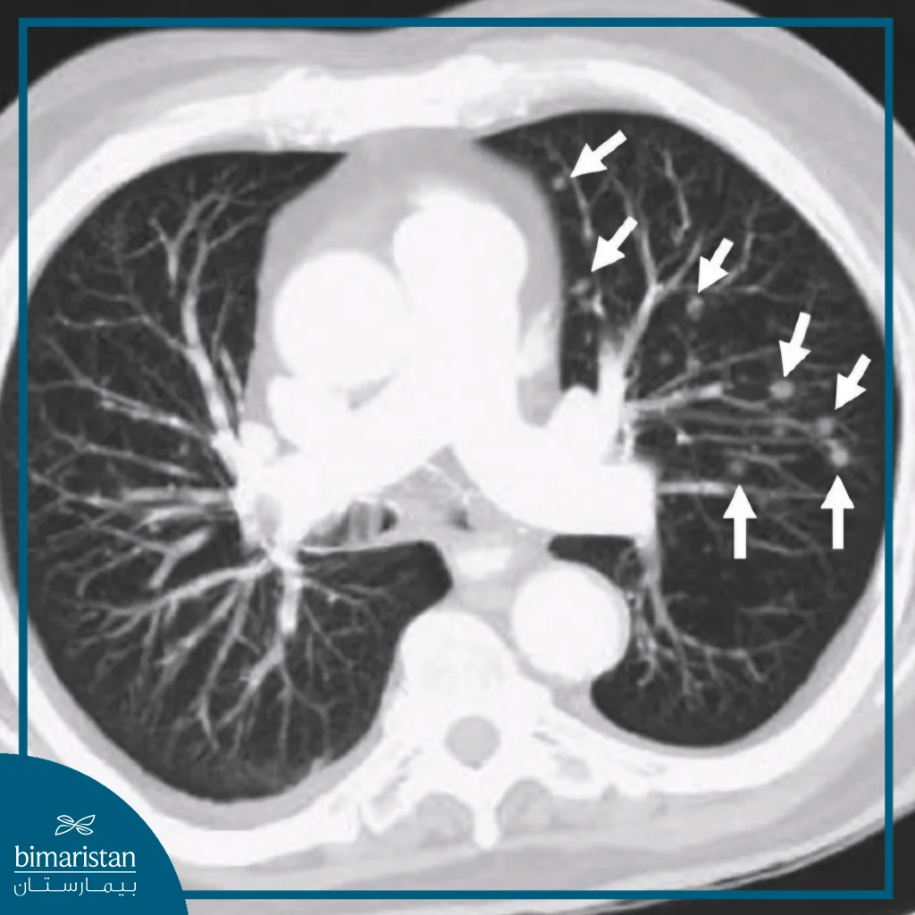 Ct Scan Showing Multiple Pulmonary Nodules In The Right Lung