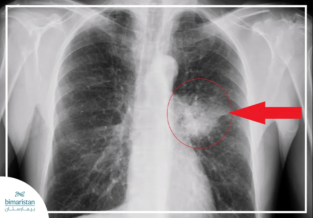 Lung Adenocarcinoma: Causes, Symptoms &Amp; Treatment 4 Chest X-Ray Showing A Suspicious Mass In The Right Lung, Indicating Lung Adenocarcinoma