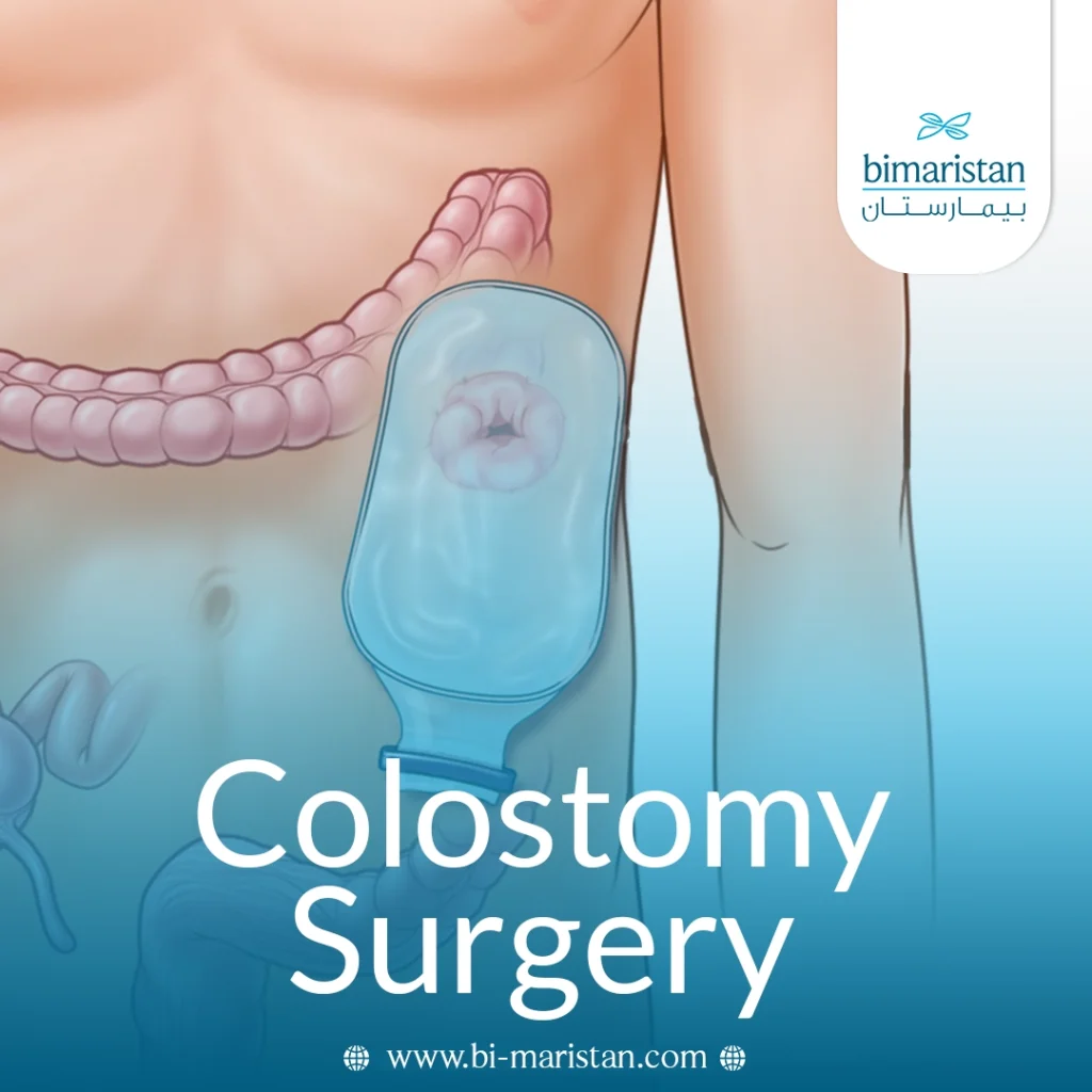Colostomy: Complete Guide To The Procedure And Post‑Op Care 5 Colostomy Surgery