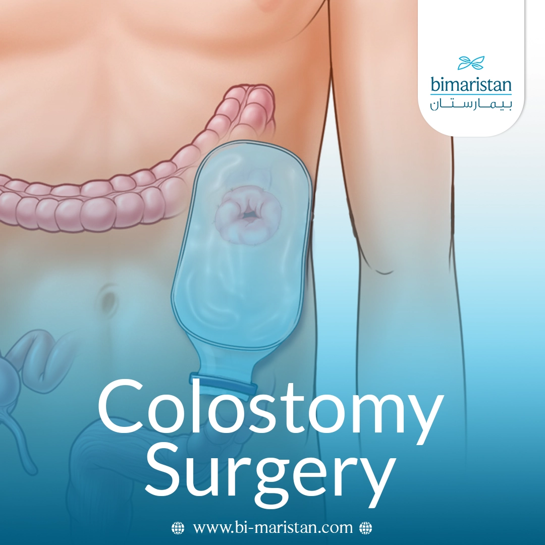 Colostomy: Complete Guide To The Procedure And Post‑Op Care 3 Colostomy: Complete Guide To The Procedure And Post‑Op Care