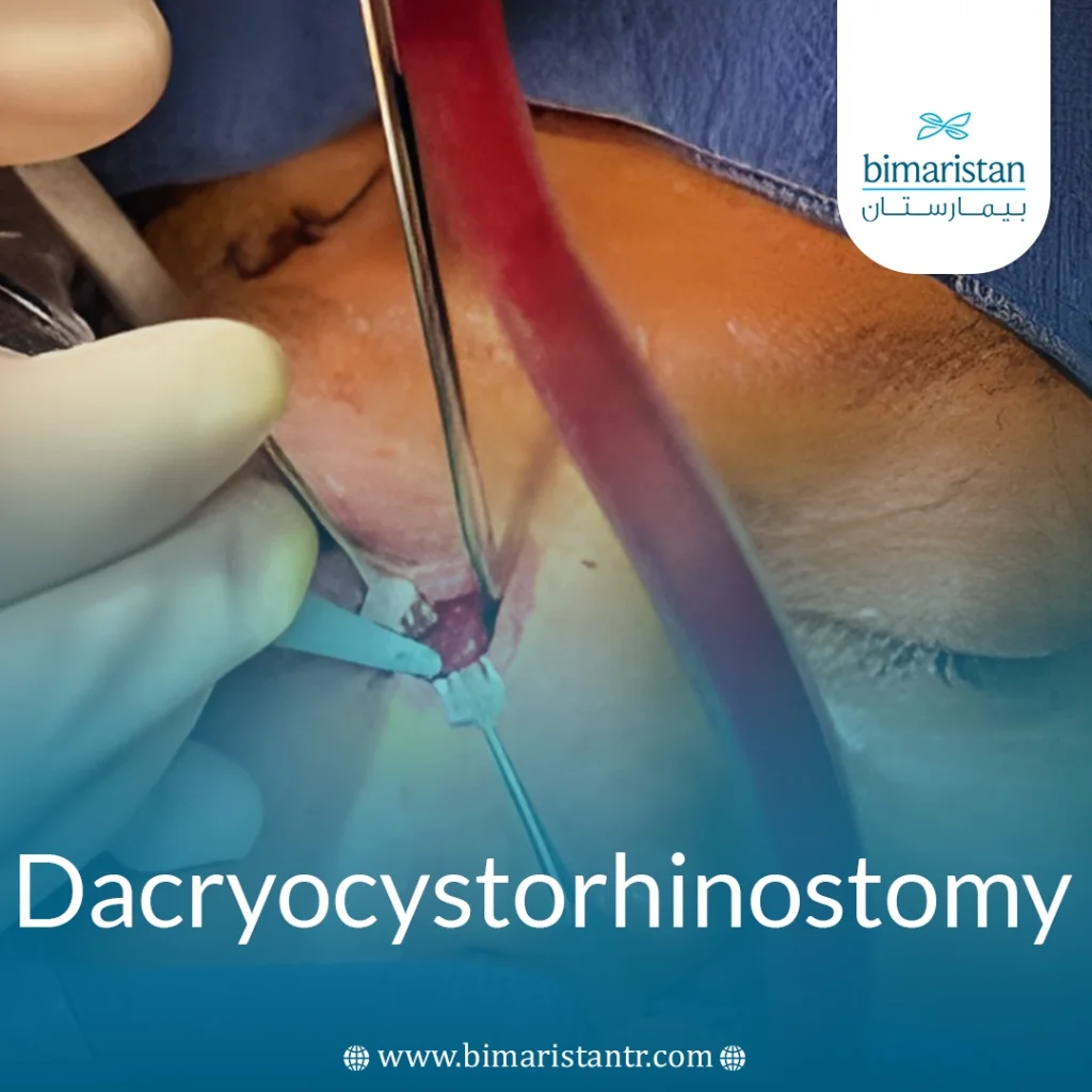 Tear Duct Obstruction Surgery