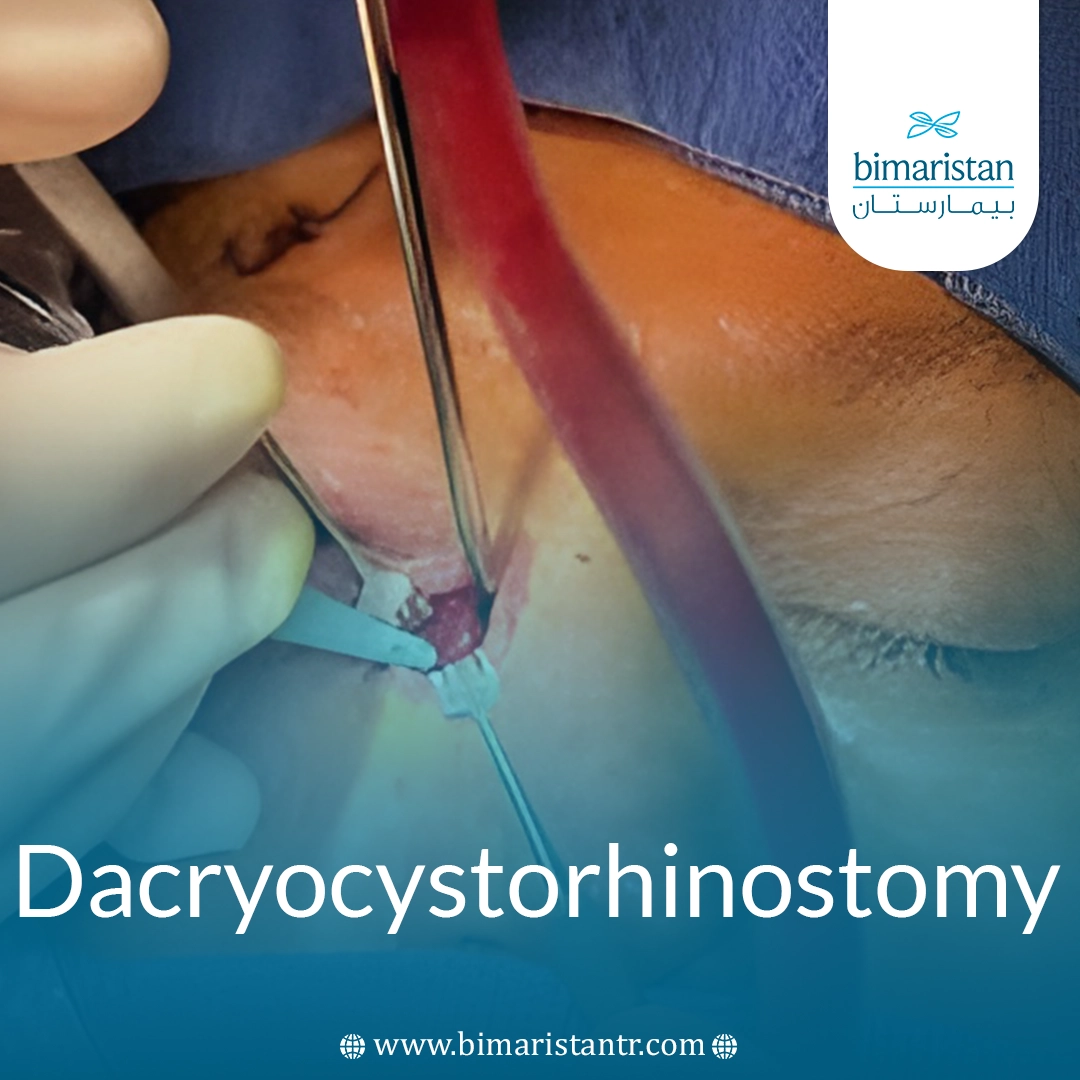 Tear Duct Obstruction Surgery: Causes And Surgical Treatment To Restore Normal Tear Flow