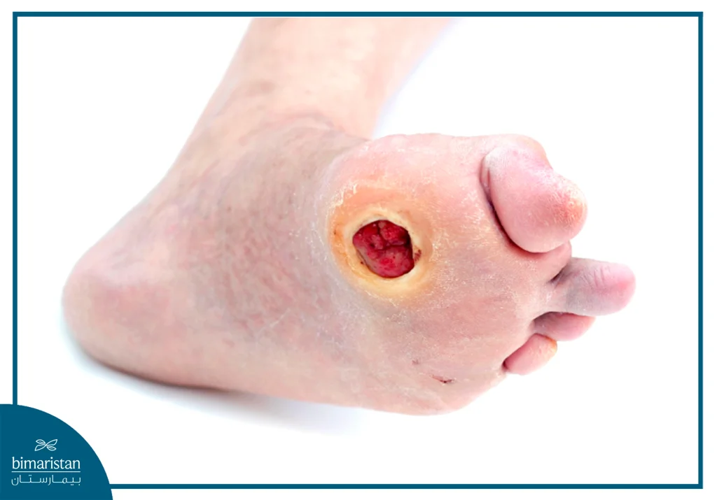 Osteomyelitis: Symptoms, Causes, And Comprehensive Treatment 6 Diabetic Foot The Main Cause Of Osteomyelitis