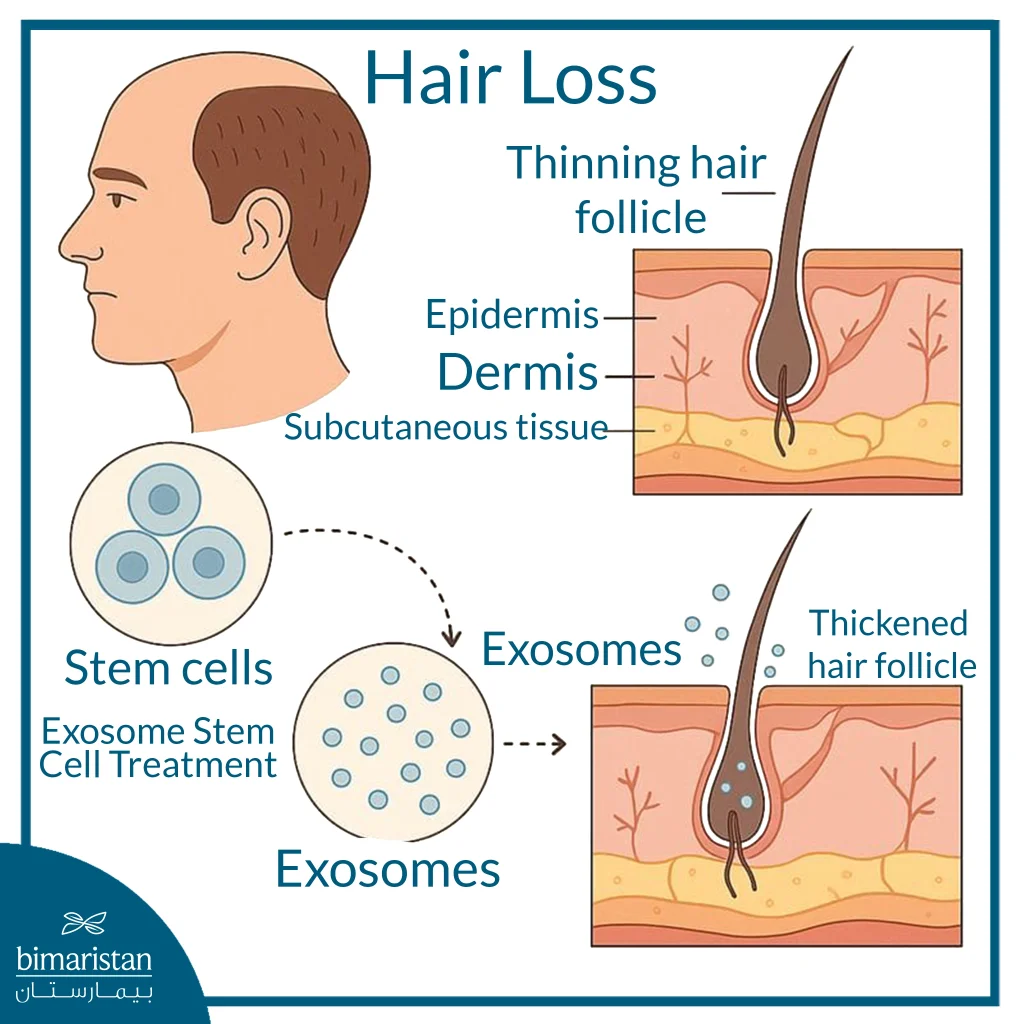 Exosome Hair Therapy: The Latest In Natural Hair Regeneration 2 Diagram Showing How Stem-Cell-Derived Exosomes Thicken And Strengthen Hair Follicles To Reduce Hair Loss.