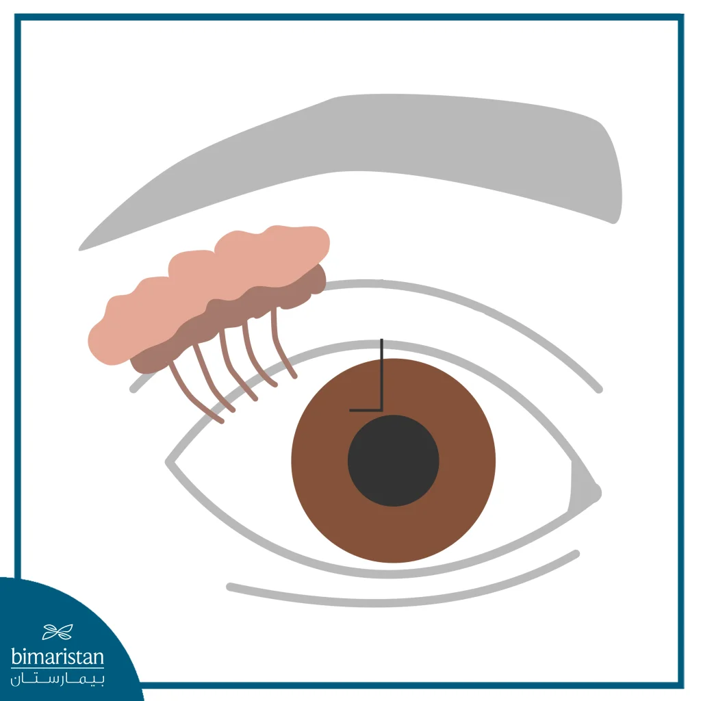 Diagram Showing The Lacrimal Gland And Tear Drainage Pathway From The Eye To The Nasal Cavity, Including The Lacrimal Ducts And Sac.