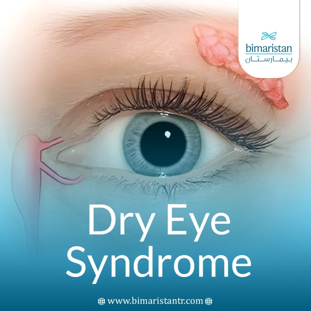 Dry Eye Syndrome