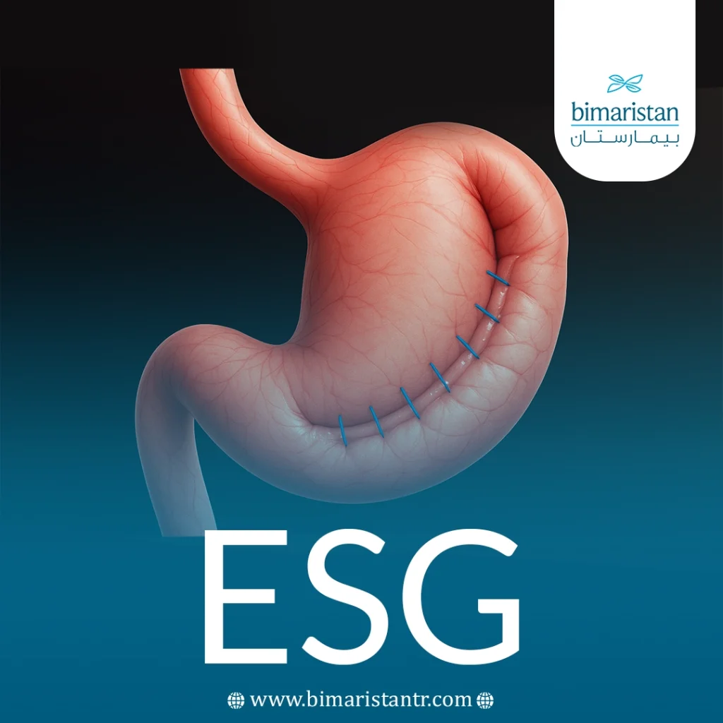 Endoscopic Sleeve Gastroplasty