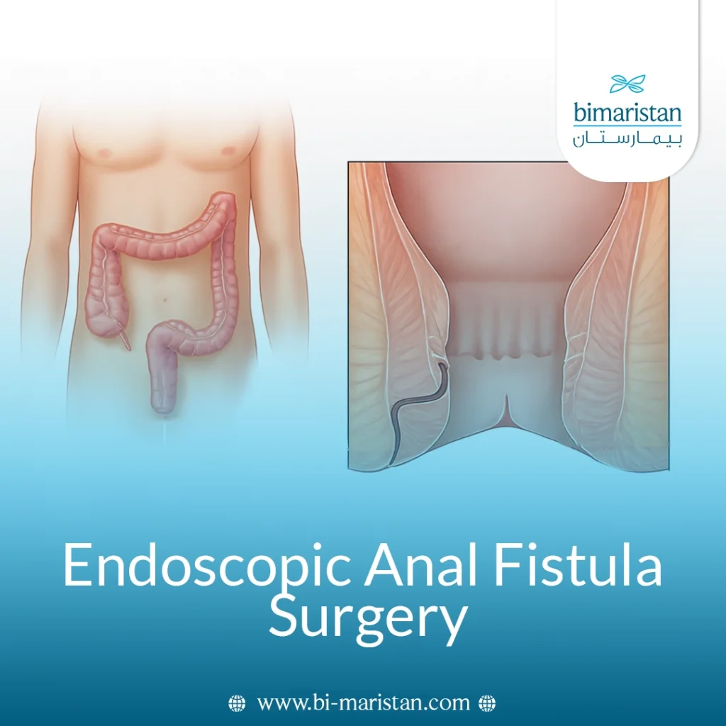 Endoscopic Anal Fistula Surgery