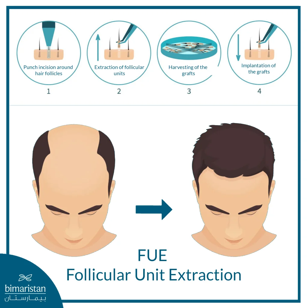 Fue Hair Transplant Cost In Turkey: Affordable Prices &Amp; European Standards 2 Fue Hair Transplant Involves Extracting Individual Hair Follicles Without Stitches Or Visible Scars