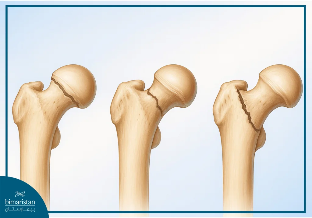 Femoral Neck Fracture Everything You Need To Know About
