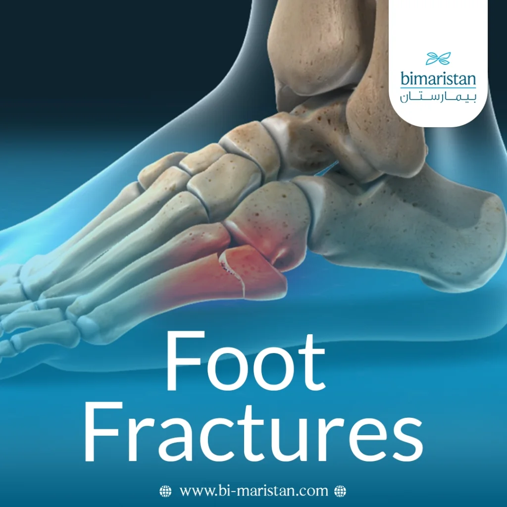 Foot Fractures