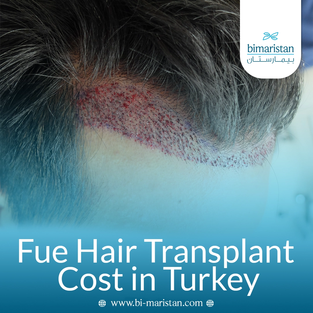 Fue Hair Transplant Cost In Turkey: Affordable Prices &Amp;Amp; European Standards 1 Fue Hair Transplant Cost In Turkey: Affordable Prices &Amp;Amp; European Standards