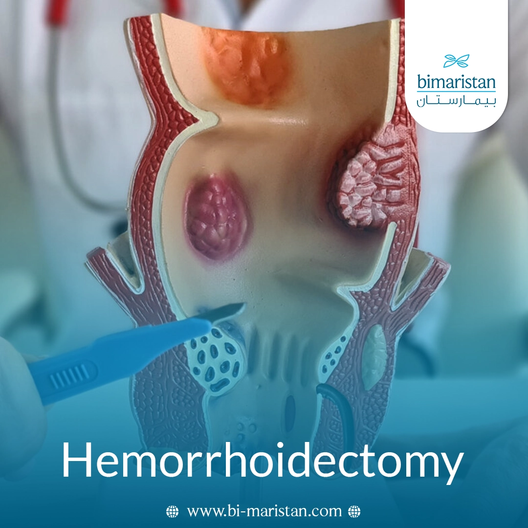 Hemorrhoidectomy