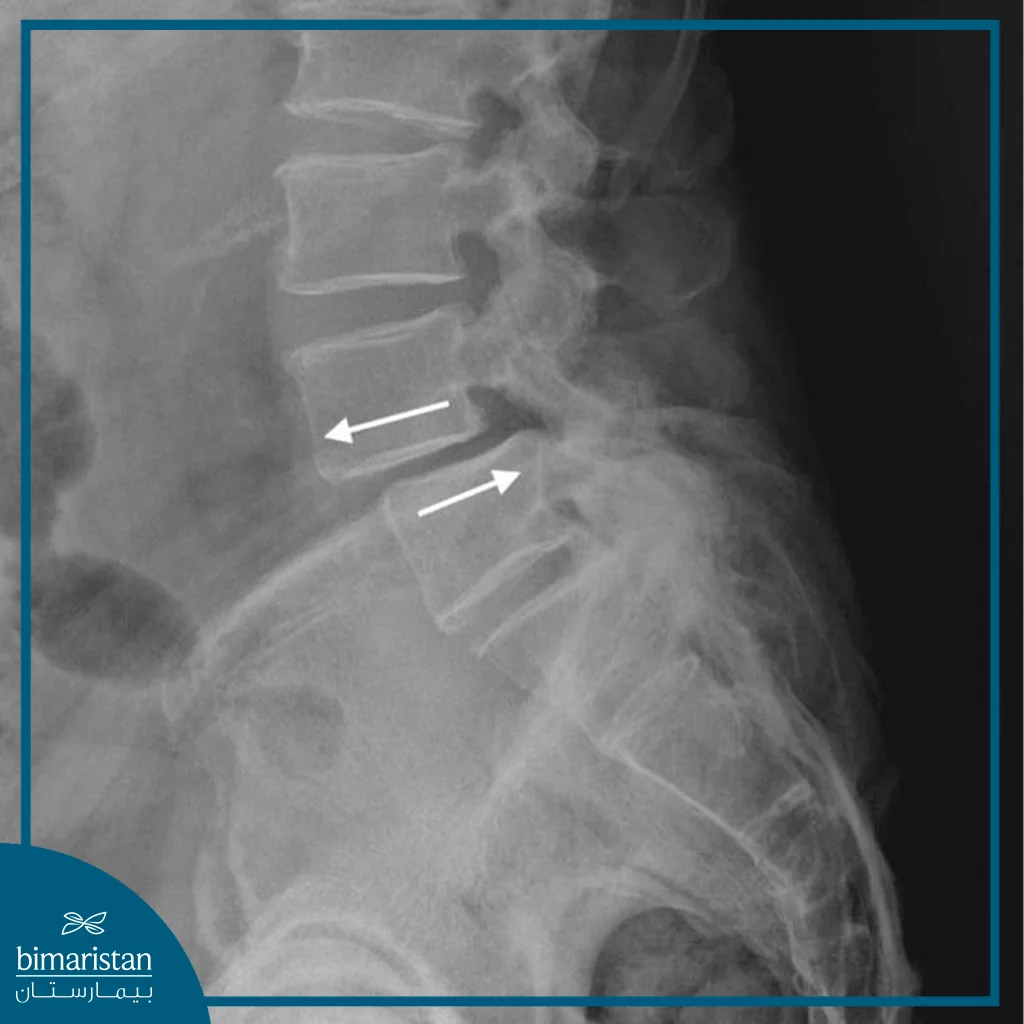 Herniated Disc One Of The Most Important Conditions That Require Spinal Fixation.