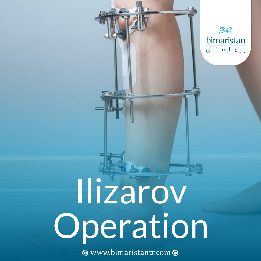 Ilizarov Operation
