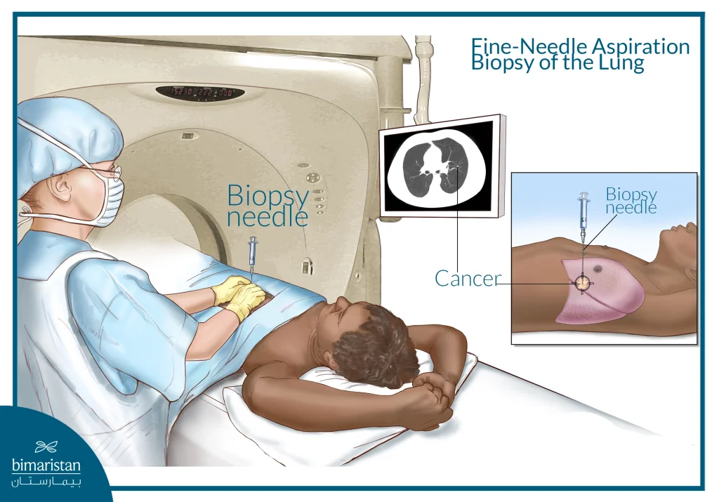 Lung Adenocarcinoma: Causes, Symptoms &Amp; Treatment 5 Illustration Showing Fine-Needle Aspiration Of The Lung To Diagnose Lung Adenocarcinoma
