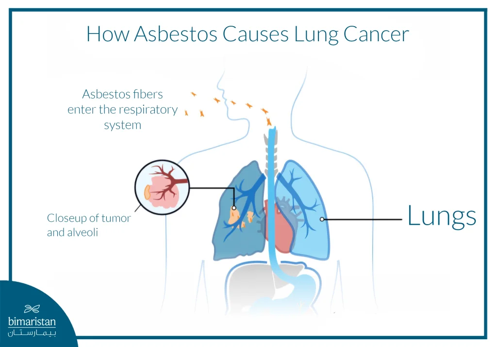 Asbestos And Lung Cancer: How Does Exposure To Asbestos Increase Your Risk? 3 Illustration Showing How Inhaled Asbestos Fibers Cause Lung Cancer