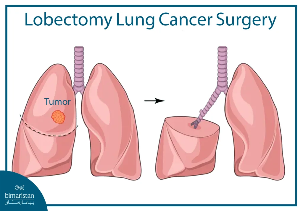 Illustration Showing Lobectomy Surgery, With The Removal Of A Lung Lobe Affected By Squamous Cell Lung Cancer